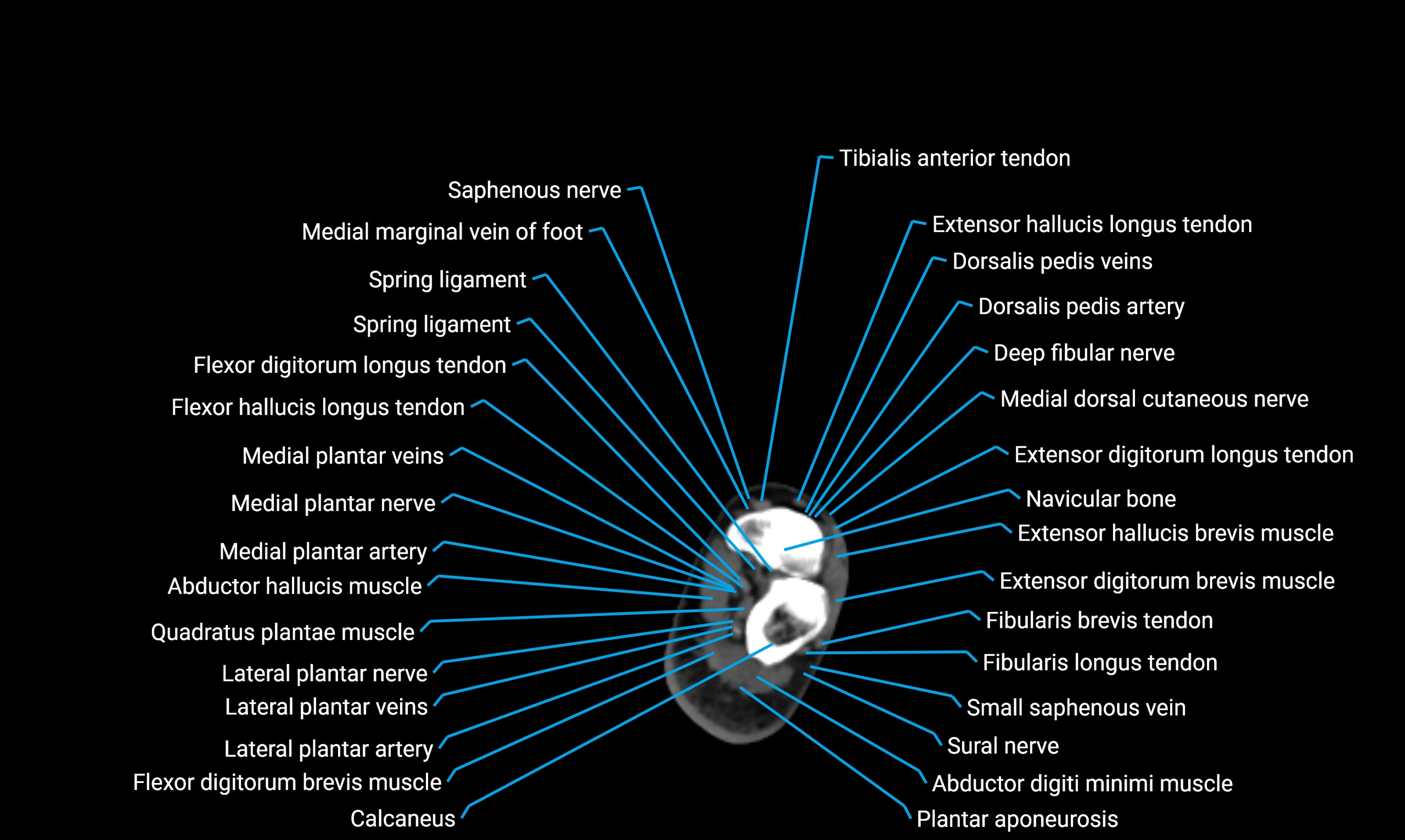 CT lower limb axial cross sectional anatomy labelled image 175 (2).webp